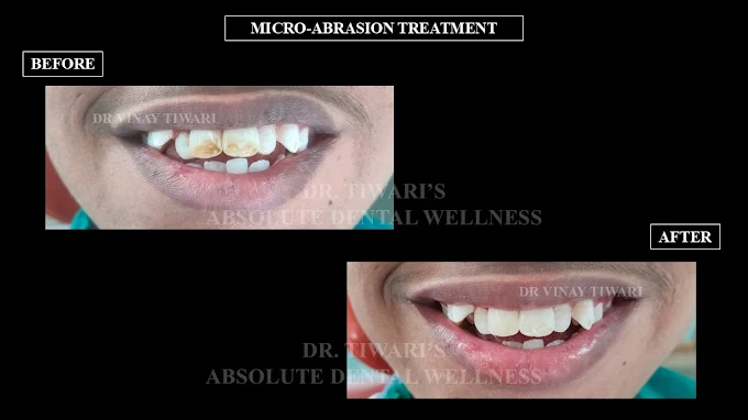 Smile Transformation 3